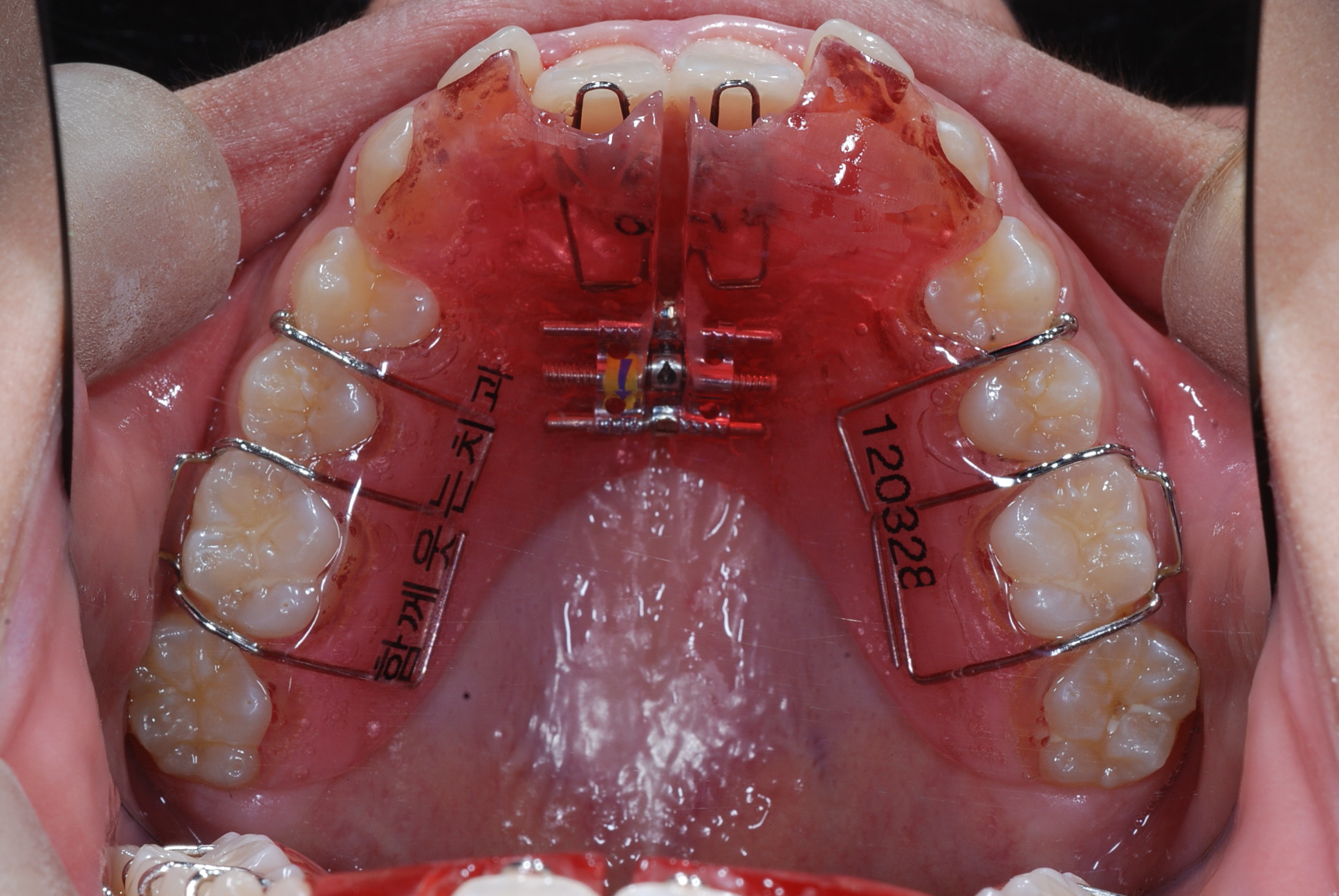 active plate2 Smile Together Dental Clinic