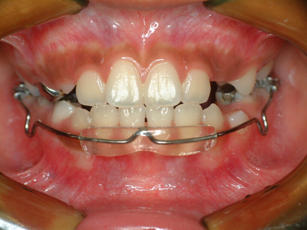 lip bumper3 Smile Together Dental Clinic
