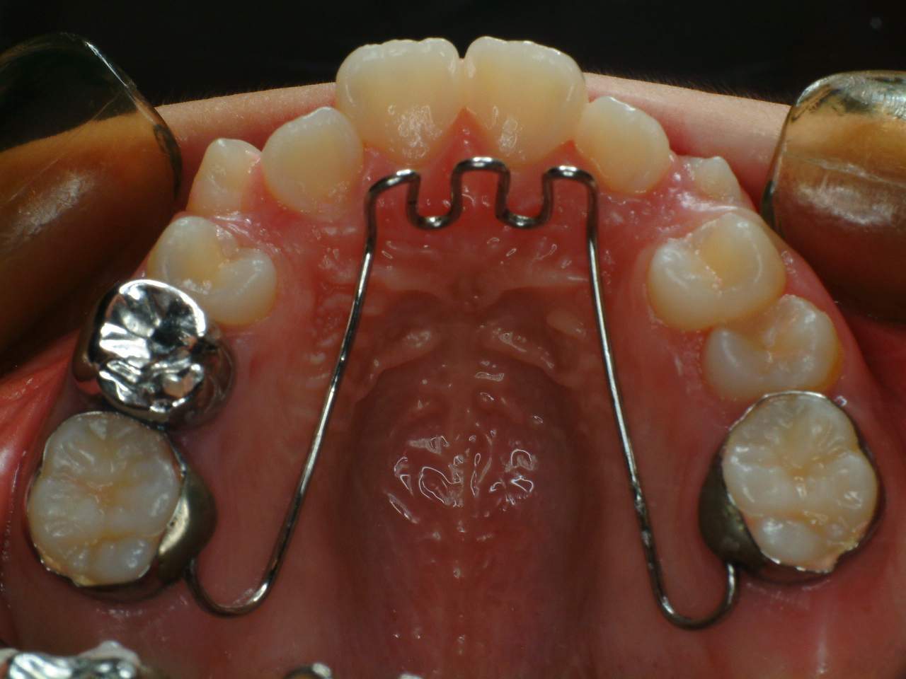 tongue crib2 Smile Together Dental Clinic